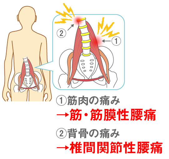 慢性腰痛